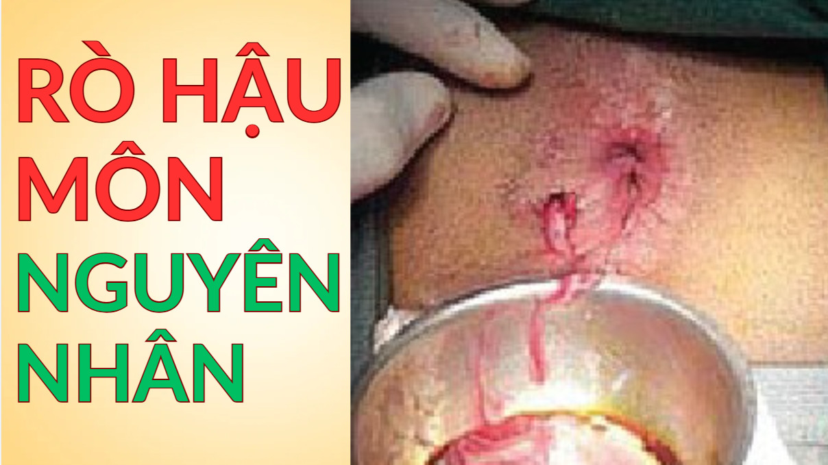 _images/nguyen-nhan-ro-hau-mon.jpg