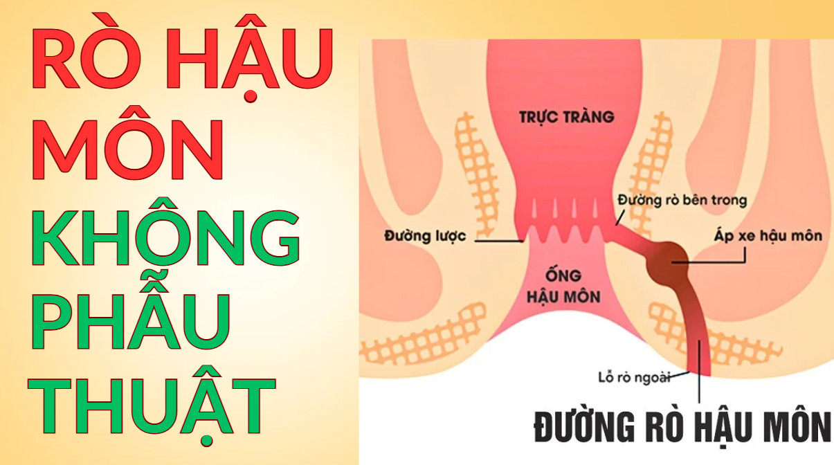 _images/ro-hau-mon-khong-phau-thuat.jpg